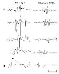 Examples Of Hippocampal Events That Were Not Considered As Sleep Download Scientific Diagram