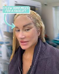 I’m 51 and flew to turkey for a facelift