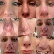 This is a blood clot that came out of my nose after surgery