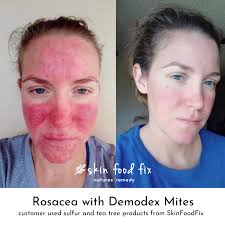 Image result for demodex rosacea