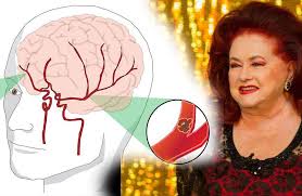 Comment détecter un avc et comment réagir ? Stela Popescu OmoratÄ De Un Accident Vascular Cerebral Care Sunt Simptomele Bolii Cum Le Recunosti Spynews Ro