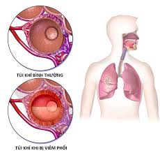 Thêm 14 ca nhiễm mới ở hải phòng, hải dương và quảng ninh. Cáº§n Lam Gi Khi Co Cac Biá»ƒu Hiá»‡n Cá»§a Covid 19 Vinmec