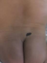 Sacral Dimple Crooked Buttcrack Spinal Birthmark Babycenter