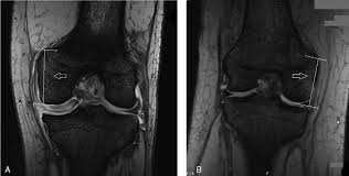By now you probably know that the anatomy is deceptively complex, combinations of injuries can be challenging, and of course the referring clinician's expectations are as high as the range of meniscus injuries is wide. Mri Image Of The Patient A Left Knee And A Normal Knee B Right Download Scientific Diagram
