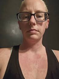 What relieves itching with lupus?