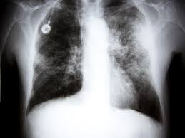 The contours of the tumor site are uneven, hilly, radiant.d. Panel Urges Lung Cancer Screening For Millions Of Americans Kpcw