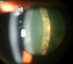 .besonders im linsenkern (cataracta nuclearis), in der linsenrinde (cataracta corticalis) oder an der hinterkapsel als so genannte hintere schalentrübung (cataracta subcapsularis posterior). Cataract Eyewiki