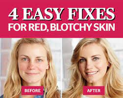 Walmart.com has been visited by 1m+ users in the past month 4 Easy Hacks To Fix Your Red Blotchy Skin Blotchy Skin Red Blotchy Skin Skin Redness
