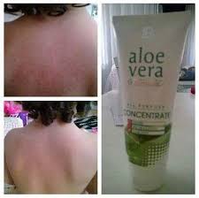Issilik Icin Lr In Aloe Vera Ozlu Concentrate Jeli Ni Kullanin Yalnizca 4 Saatte Gerceklesen Etkisini Gozleriniz Ile Gorun Detayli Bilgi Icin Bana Movimiento