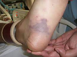 It is sometimes associated with symmetrical peripheral gangrene (tissue death affecting hands and feet). Disseminated Intravascular Coagulation Dic Consumptive Coagulopathy Purpura Fulminans Dermatology Advisor