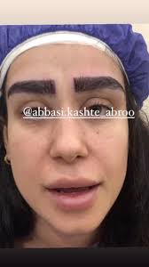 کاشت ابرو و مو طبیعی‎ (@abbasi.kashte_abroo) • Instagram photos and videos