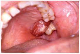 Mesothelioma, also known as malignant mesothelioma, is an aggressive malignant tumor of the mesothelium. Metastasis Of Mesothelioma To The Maxillary Gingiva