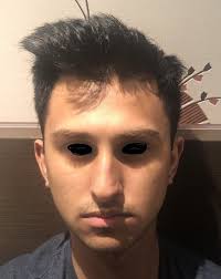 Dehydration can also give your cheeks a hollow appearance. Hollow Cheeks Chiseled Jawline Reshape Face Difference Between Custom And Normal Implants Photos