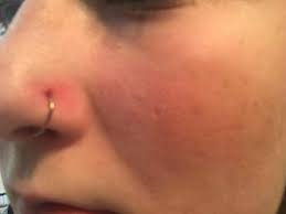 Das sollten sie über schmerzen und mögliche risiken beim stechen von nasenpiercings wissen. Nasen Piercing Gestochen Jetzt Habe Ich So Ein Blaschen Was Ist Das Nasenpiercing