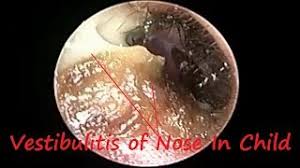The inner lining of the nose may become inflamed for several reasons, and constant irritation of the membranes will cause them to thin and weaken. Vestibulitis Common In Child Due To Rhinitis Sinusitis Nasal Allergy Adenoid Hypertrophy Youtube