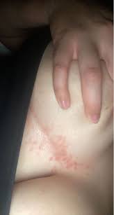 Image result for heat rash under breasts