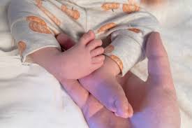 Image result for Clubfoot
