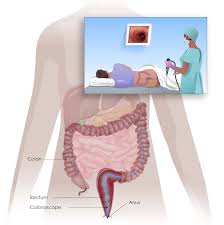 Image result for Colon Cancer Screening with Colonoscopy