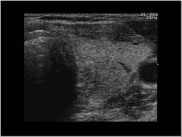 Ultrasound is used to see the thyroid gland and the lymph nodes of the neck. Head And Neck 4 1 Thyroid Gland Case 4 1 4 Thyroiditis And Diffuse Thyroid Disease Ultrasound Cases