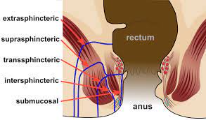 Obstetric fistula is a childbirth injury that happens when a woman experiences obstructed labor and finds herself with no access to the care she needs to give birth safely. Anal Fistula Surgery In Dubai Dr Antonio Privitera