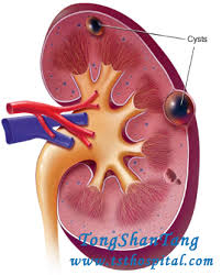 Is A Kidney Cyst Measuring 4x4x5 Cm Large Enough To Be Drained Kidney Cyst Kidney Cyst Symptoms Kidney Disease