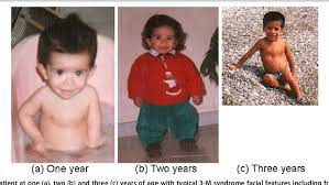 Growth hormone deficiency (ghd), or human growth hormone deficiency, is a medical condition resulting from not enough growth hormone (gh). Figure 1 From 3 M Syndrome Associated With Growth Hormone Deficiency 18 Year Follow Up Of A Patient Semantic Scholar