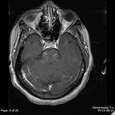Current literature only reports a few cases journal of the belgian society of radiology. Chronic Lymphocytic Inflammation With Pontine Perivascular Enhancement Responsive To Steroids Clippers Radiology Reference Article Radiopaedia Org