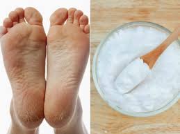 Como Eliminar Las Grietas Y Mal Olor De Los Pies