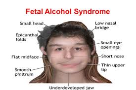 He now has sensory integration disorder, although he doesn't seem to have any other health or cognitive problems. Maxes On Twitter Fetal Alcohol Syndrome Yandere Dev