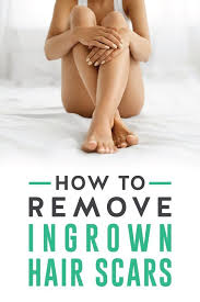 It is common for ingrown hair bump to leave scars after healing. Discolored And Scarred Skin From An Ingrown Hair Scar Can Be Effectively Diminished By Following A Routine Th Ingrown Hair Scar Ingrown Hair Treat Ingrown Hair
