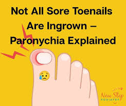 Image result for Paronychia feet