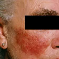 Image result for red rash face