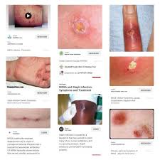 Pin By Irene Du Preez On Psoriasis Neurodermitis Dyshidrotische Ekzeme Mrsa Staph Infection Autoimmune Disease