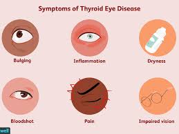 Treatment includes antithyroid drugs or medications, radiation therapy with radioactive iodine and surgery. Thyroid Eye Disease Symptoms Causes Diagnosis And Treatment