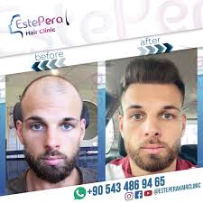 However, it's important to realize that not all hair loss is the same and results depend on your hair loss cause, hair loss classification, as well as other factors. Hair Transplant Turkey Istanbul Estepera Hair Clinic