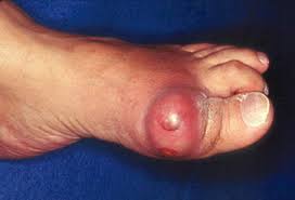 Maybe you would like to learn more about one of these? Gout Attack Symptoms Causes Treatment And Diet