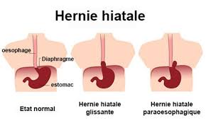 Chaque intervention est une véritable course. Hernie Hiatale Symptomes Traitement Definition Docteurclic Com