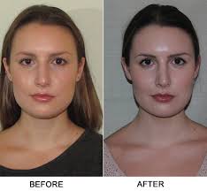 After surgery to remove polyps in the nose and the patient will have to undergo rehabilitation at the clinic. Turbinate Reduction Photos New York Ny Sinus Surgeon