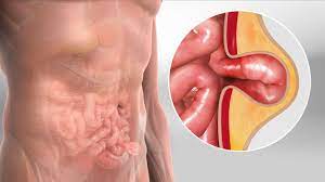Laparoscopic Hernia Repair - Keck Medicine Of Usc