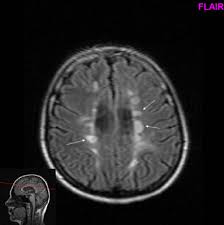 It does not provide medical advice, diagnosis or treatment. Roztrousena Skleroza Pgs Wikiskripta