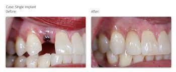 Pin On Complete Dentistry Article