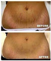 Do You Have Stretch Marks You Want To Get Rid Of Try Our All Natural Stretch Mark Cream At My Price For Stretch Mark Remedies Stretch Mark Cream Stretch Marks