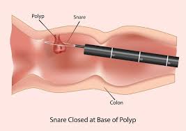 Having one or more risk factors does not mean you will definitely get bowel cancer. Colorectal Cancer Increase In Younger Adults What Could Be The Cause