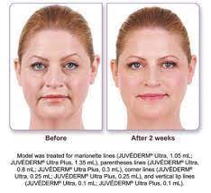 Best filler for marionette lines. 10 Fixes Ideas Dermal Fillers Marionette Lines Botox