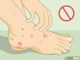 Image result for pompholyx soles of feet