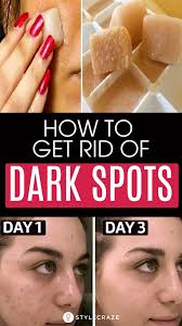 Apply it over the face and leave it for 10 minutes. How To Remove Dark Spots On Face Fast 6 Home Remedies Brown Spots Removal Dark Spots On Skin Acne Dark Spots