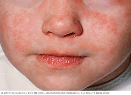 Image result for measles