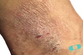 Image result for Neurodermatitis