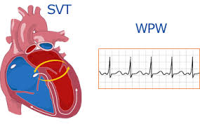 Pin By Nonas Arc On Wolff Parkinson White Syndrome Wolff Parkinson White Syndrome Fast Heart Rate Causes Fast Heart Rate