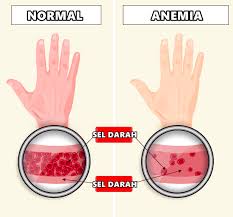 Hasil gambar untuk anemia